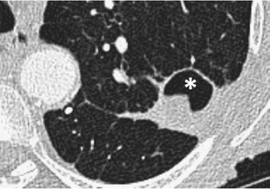 【思路拓展】哪些病变会引起肺空洞？