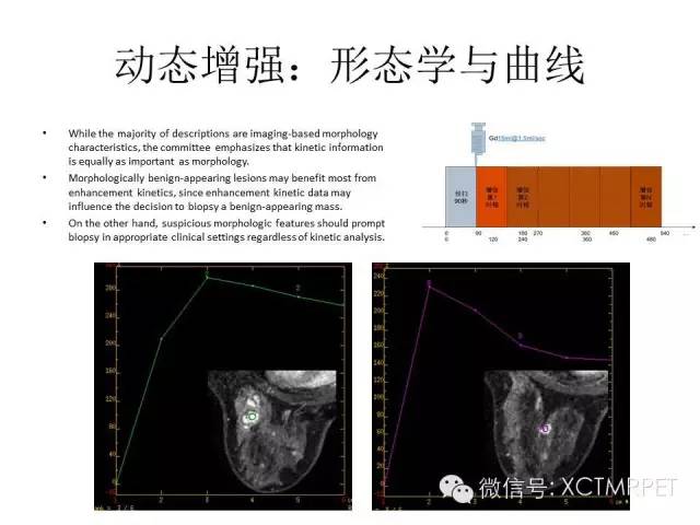 乳腺MRI：从检查到诊断