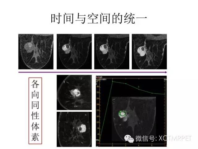乳腺MRI：从检查到诊断