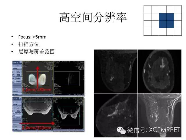 乳腺MRI：从检查到诊断