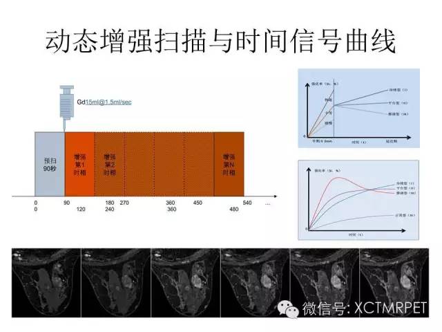 乳腺MRI：从检查到诊断