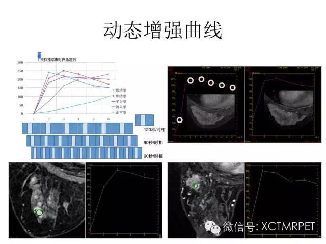 乳腺MRI：从检查到诊断