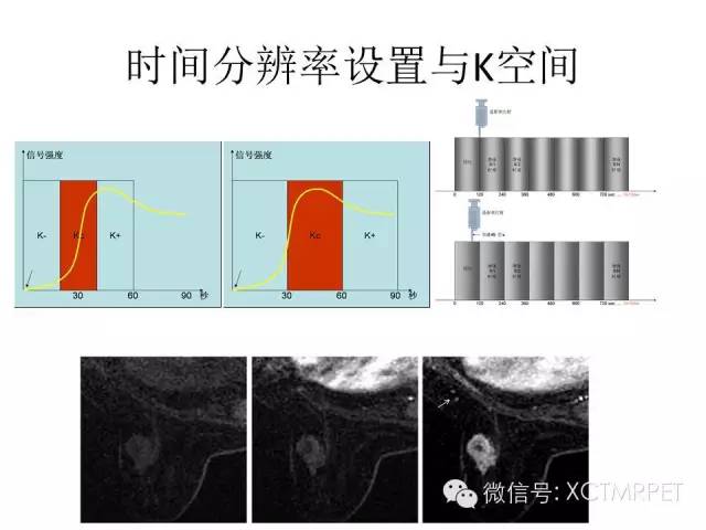 乳腺MRI：从检查到诊断