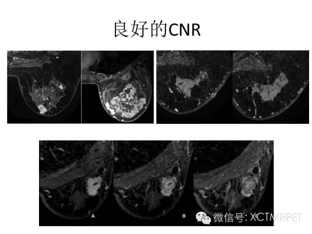 乳腺MRI：从检查到诊断