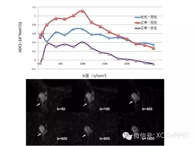 乳腺MRI：从检查到诊断