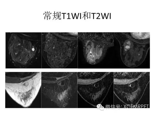 乳腺MRI：从检查到诊断