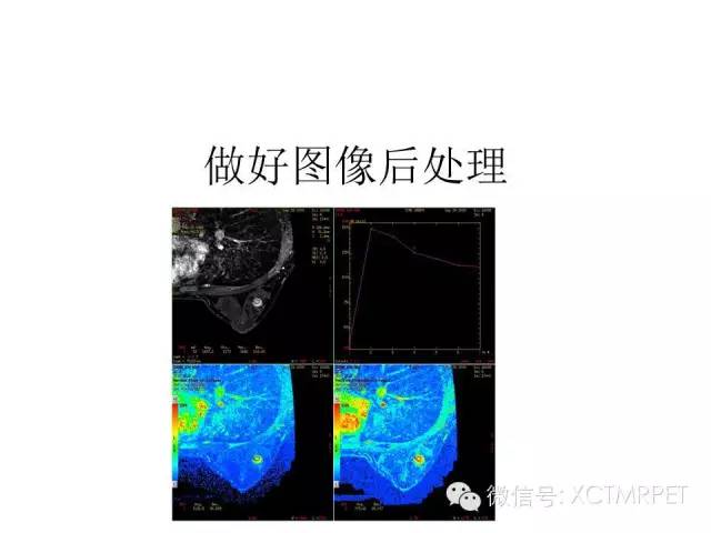 乳腺MRI：从检查到诊断