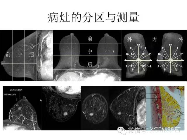 乳腺MRI：从检查到诊断