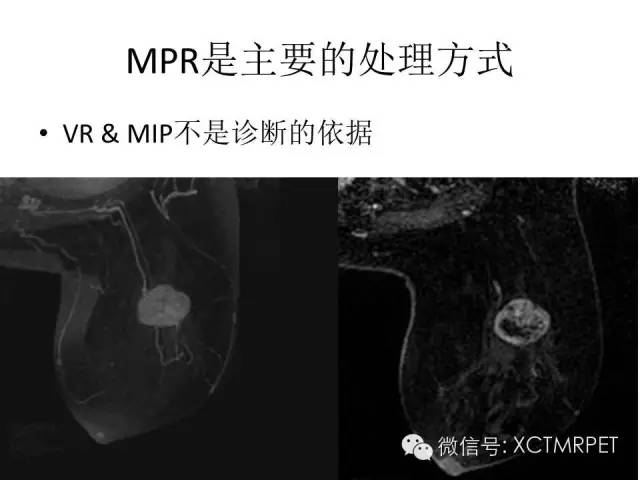 乳腺MRI：从检查到诊断