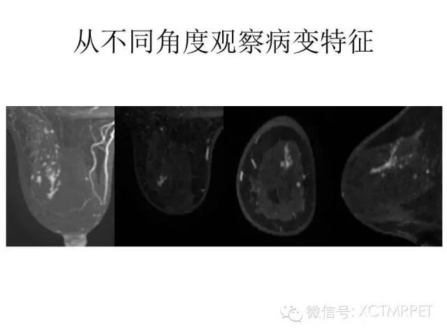 乳腺MRI：从检查到诊断