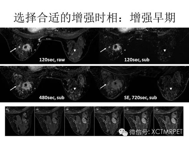 乳腺MRI：从检查到诊断