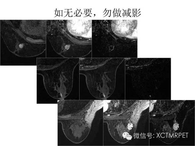 乳腺MRI：从检查到诊断