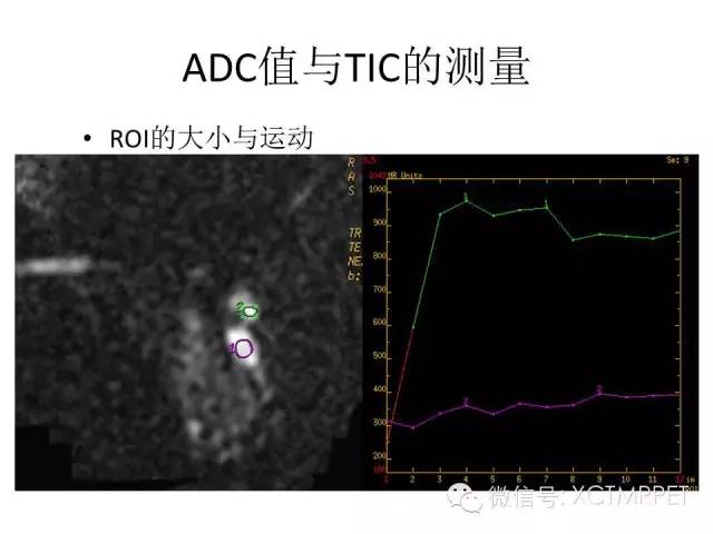 乳腺MRI：从检查到诊断