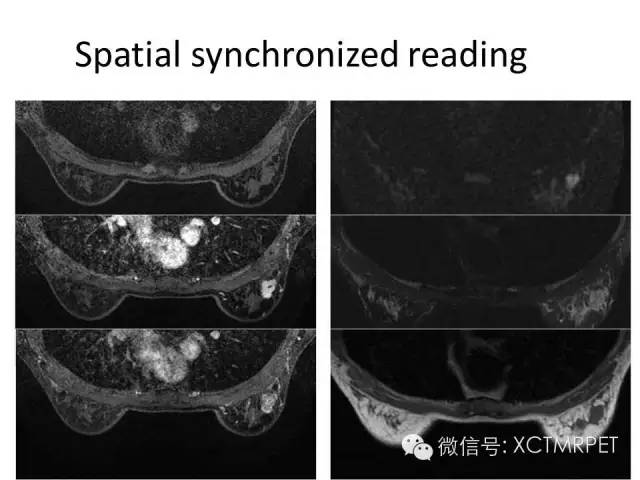 乳腺MRI：从检查到诊断