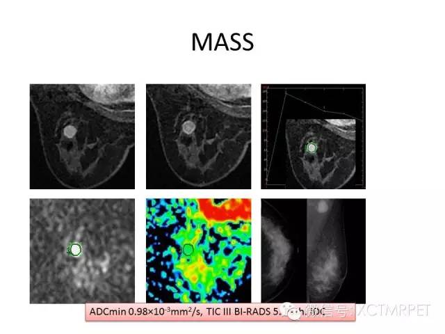 乳腺MRI：从检查到诊断