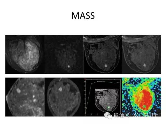 乳腺MRI：从检查到诊断
