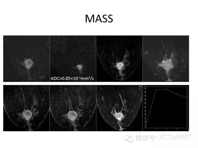 乳腺MRI：从检查到诊断