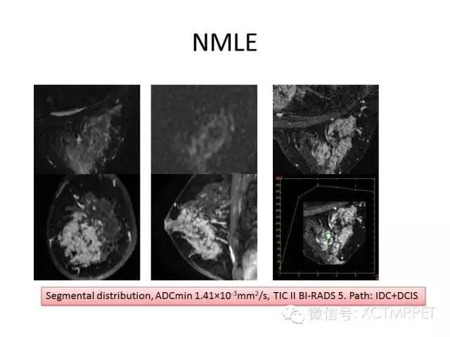 乳腺MRI：从检查到诊断