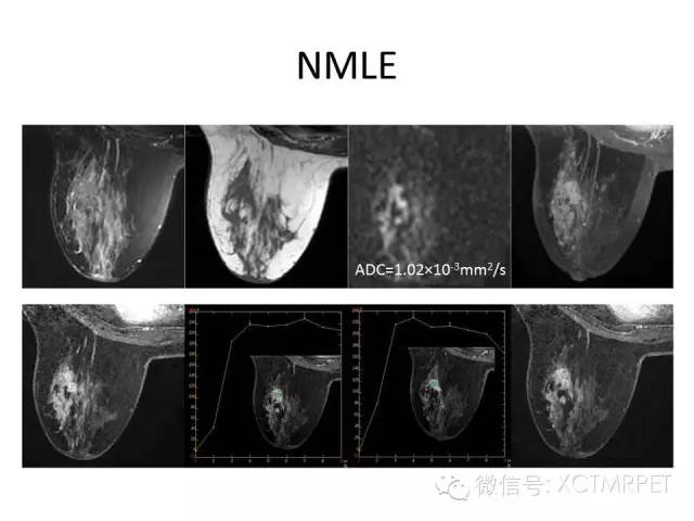 乳腺MRI：从检查到诊断