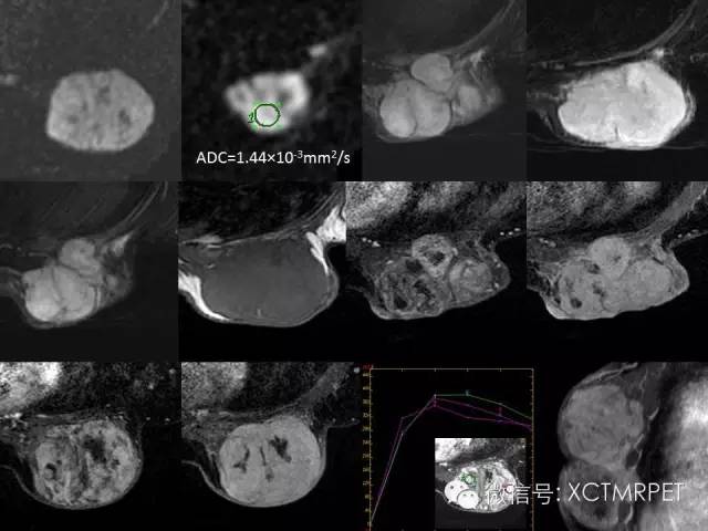 乳腺MRI：从检查到诊断