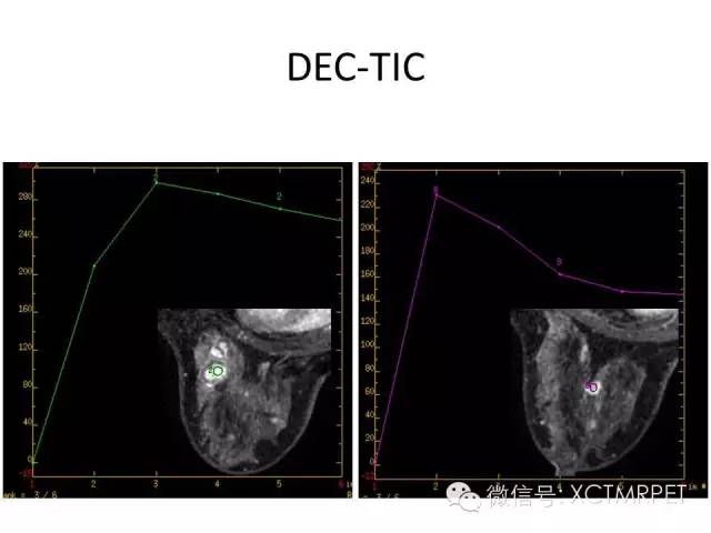 乳腺MRI：从检查到诊断