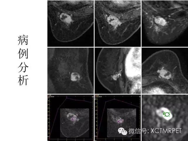 乳腺MRI：从检查到诊断