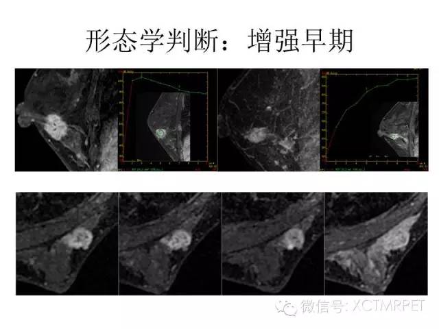 乳腺MRI：从检查到诊断