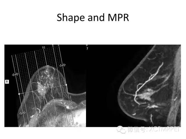 乳腺MRI：从检查到诊断