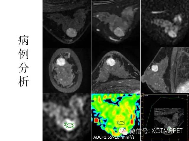乳腺MRI：从检查到诊断