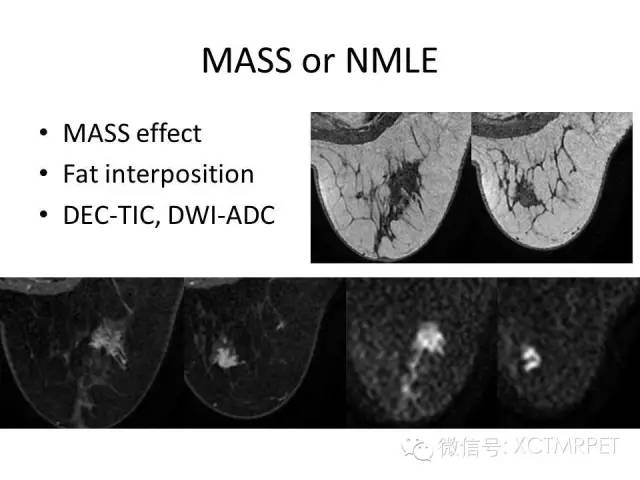乳腺MRI：从检查到诊断