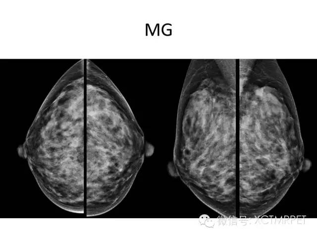 乳腺MRI：从检查到诊断