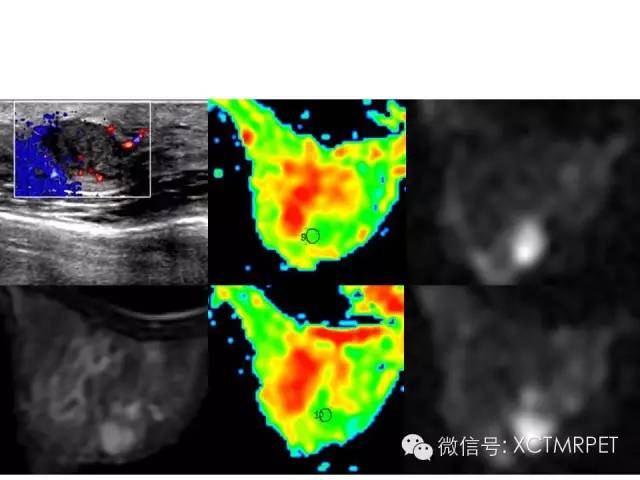 乳腺MRI：从检查到诊断