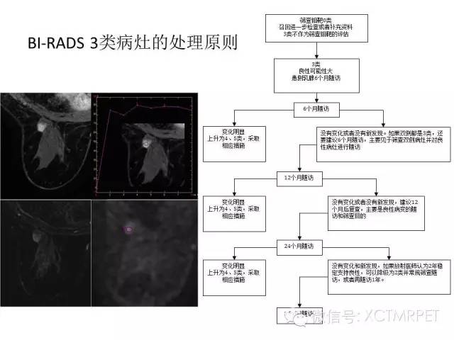 乳腺MRI：从检查到诊断