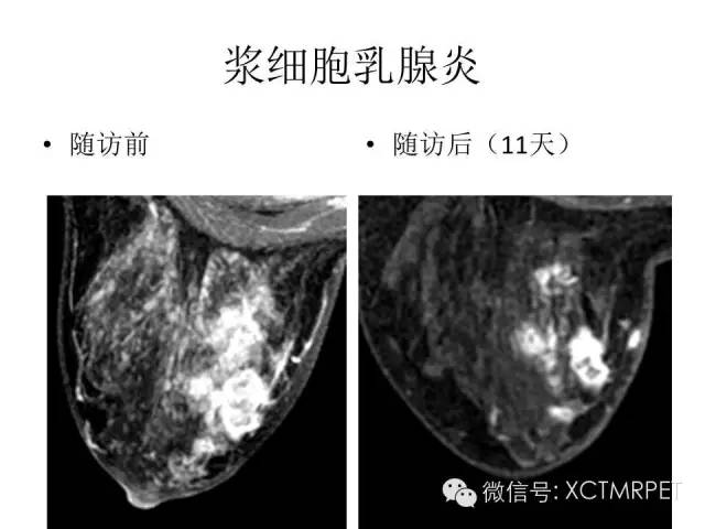 乳腺MRI：从检查到诊断