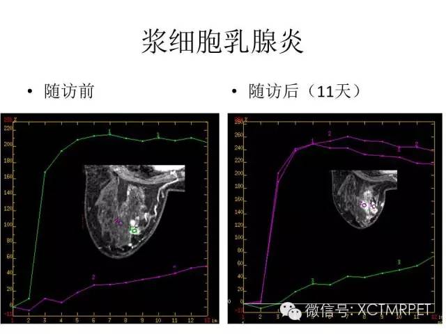 乳腺MRI：从检查到诊断