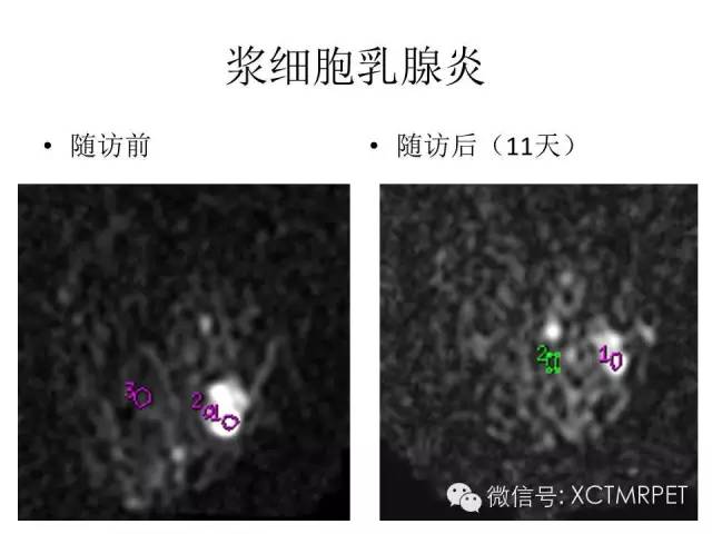 乳腺MRI：从检查到诊断