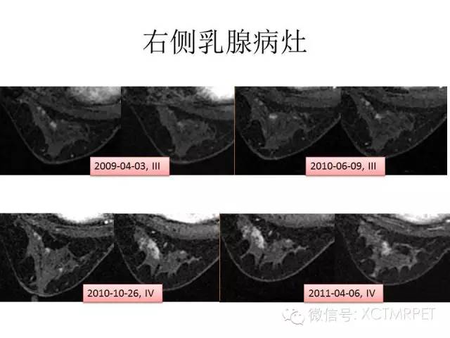 乳腺MRI：从检查到诊断