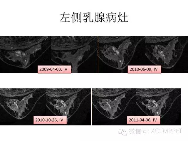 乳腺MRI：从检查到诊断