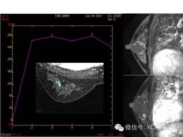 乳腺MRI：从检查到诊断