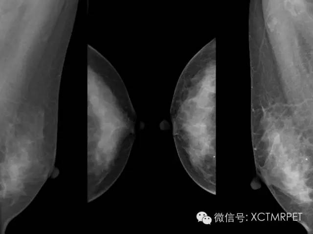 乳腺MRI：从检查到诊断