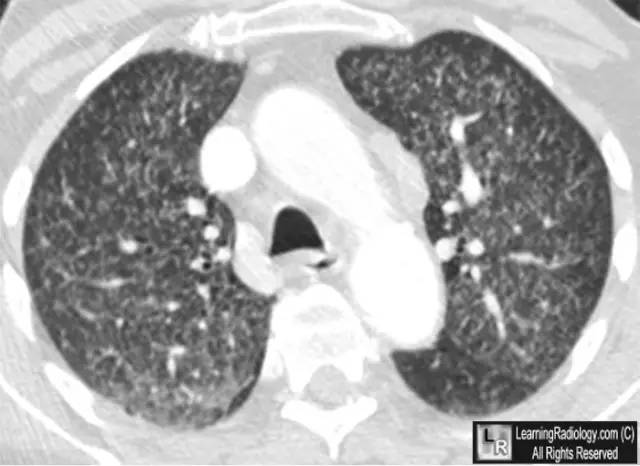 【病例学习】粟粒性结核一例CT诊断与鉴别 【病例学习】粟粒性结核一例CT诊断与鉴别