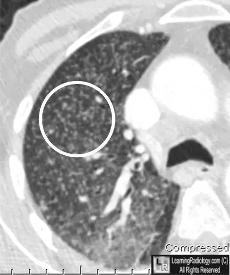 【病例学习】粟粒性结核一例CT诊断与鉴别 【病例学习】粟粒性结核一例CT诊断与鉴别