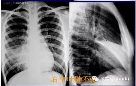 胸部常见病变的x线片总结