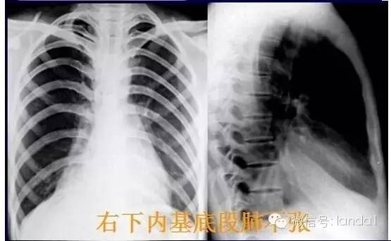 胸部常见病变的x线片总结