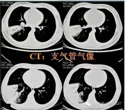 胸部常见病变的x线片总结