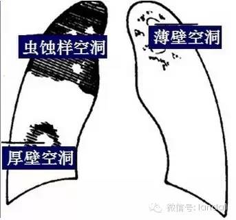 胸部常见病变的x线片总结