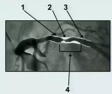 冠脉造影阅片要领 冠脉造影阅片要领