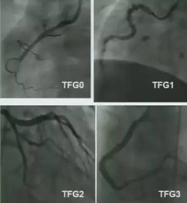 冠脉造影阅片要领 冠脉造影阅片要领