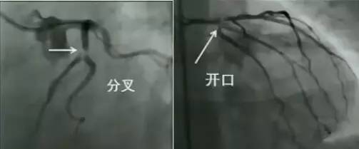 冠脉造影阅片要领 冠脉造影阅片要领