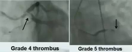 冠脉造影阅片要领 冠脉造影阅片要领